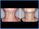 Before And After image of  Botox Migraine
