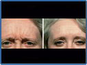 Photo1 of Before And After Botox Migraine