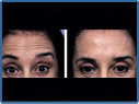 Photo 4 of Before And After Botox Migraine