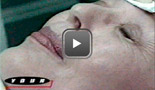 Botox Migraine Video